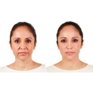Alternative view of JUVEDERM ULTRA 2 (2x0,55ml)